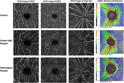 Reduced Radial Peripapillary Capillary in Pathological Myopia Is Correlated With Visual Acuity